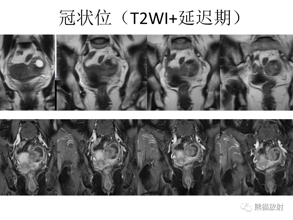 影像PPT - 【病例】卵巢卵泡膜纤维瘤2例MR影像-25