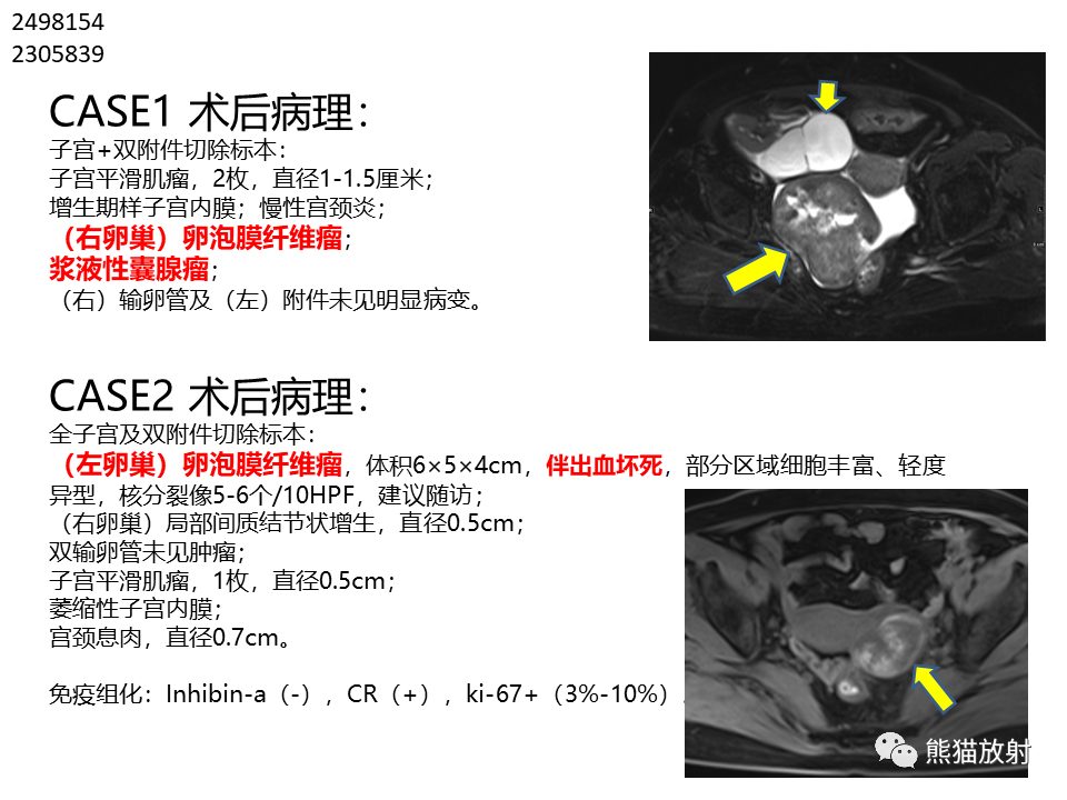 影像PPT - 【病例】卵巢卵泡膜纤维瘤2例MR影像-28