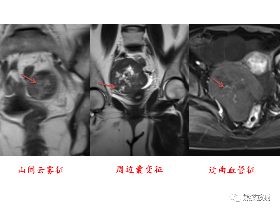 影像PPT - 【病例】卵巢卵泡膜纤维瘤2例MR影像-37