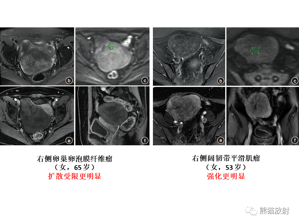 影像PPT - 【病例】卵巢卵泡膜纤维瘤2例MR影像-42