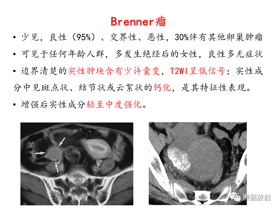 影像PPT - 【病例】卵巢卵泡膜纤维瘤2例MR影像-46