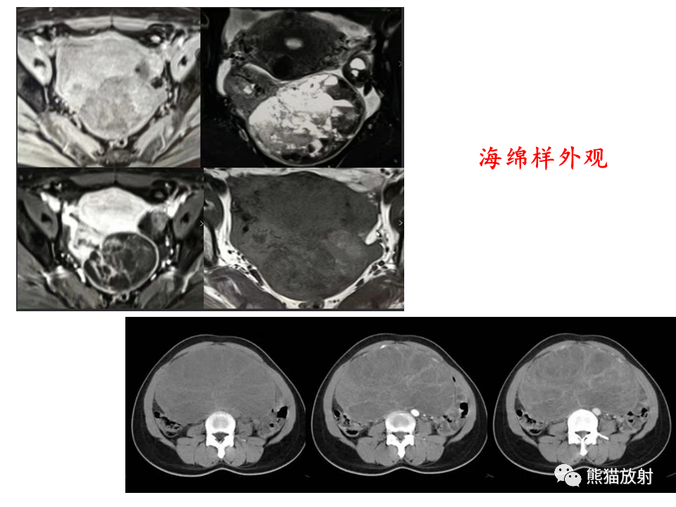 影像PPT - 【病例】卵巢卵泡膜纤维瘤2例MR影像-44
