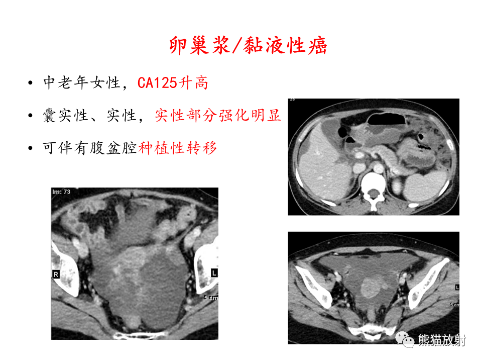 影像PPT - 【病例】卵巢卵泡膜纤维瘤2例MR影像-45