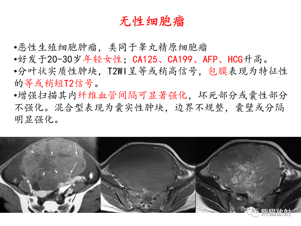 影像PPT - 【病例】卵巢卵泡膜纤维瘤2例MR影像-47