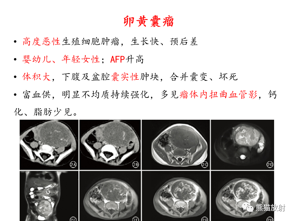影像PPT - 【病例】卵巢卵泡膜纤维瘤2例MR影像-48