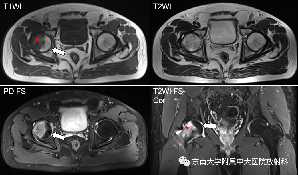 影像PPT - 【PPT】髋关节暂时性骨质疏松症TOH-1