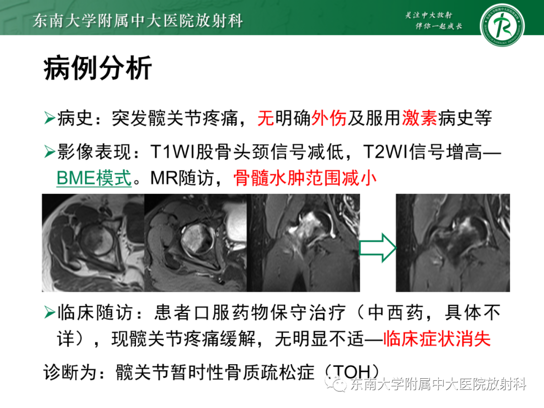 影像PPT - 【PPT】髋关节暂时性骨质疏松症TOH-3