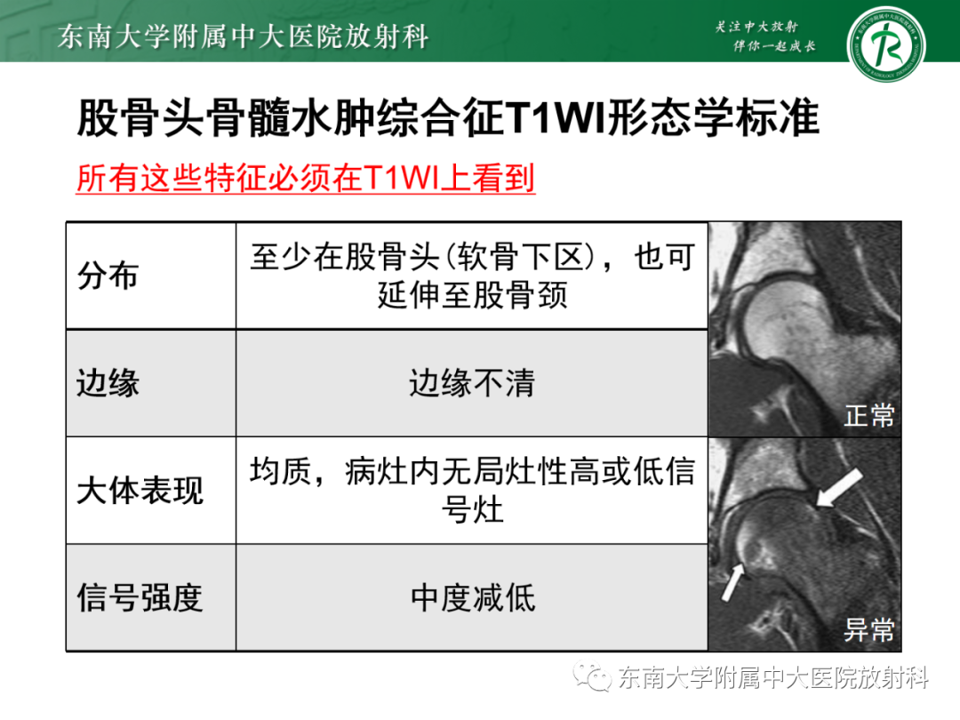 影像PPT - 【PPT】髋关节暂时性骨质疏松症TOH-6