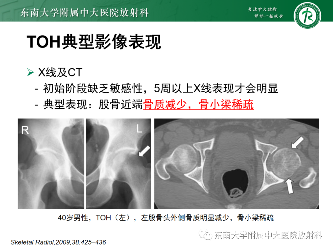影像PPT - 【PPT】髋关节暂时性骨质疏松症TOH-11