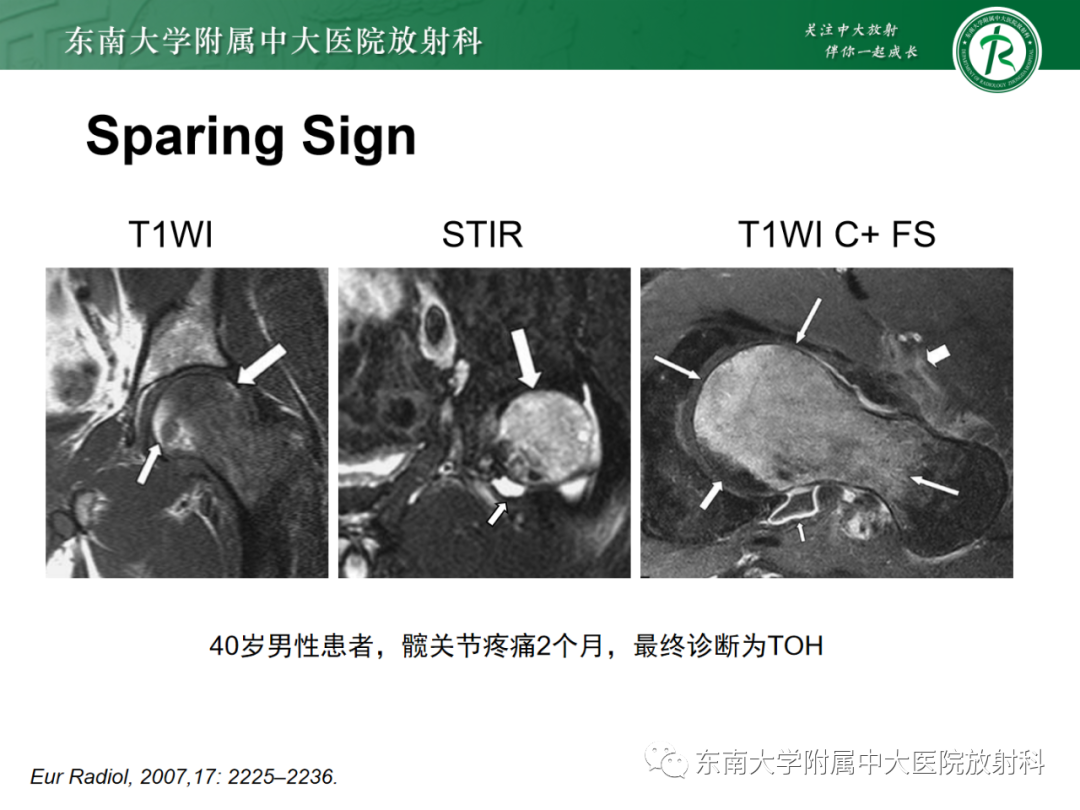 影像PPT - 【PPT】髋关节暂时性骨质疏松症TOH-14