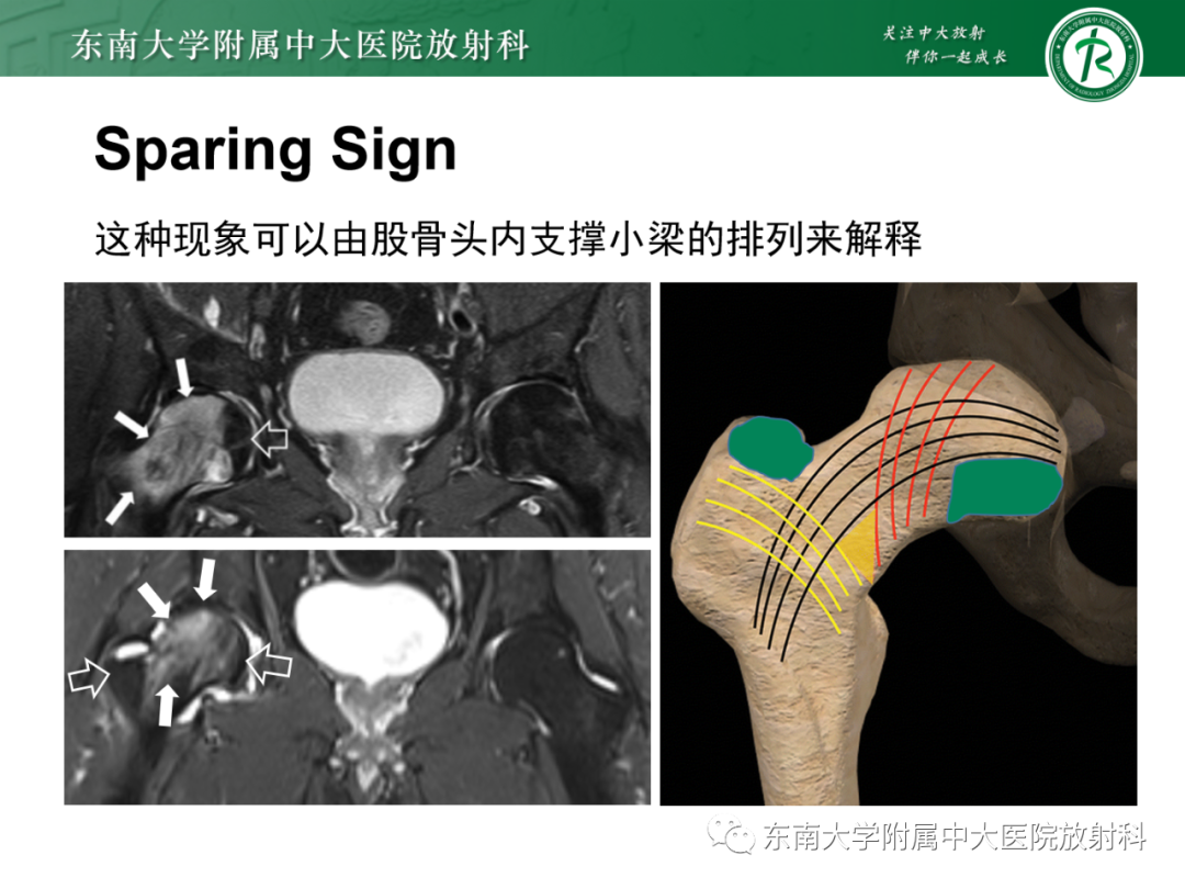 影像PPT - 【PPT】髋关节暂时性骨质疏松症TOH-13