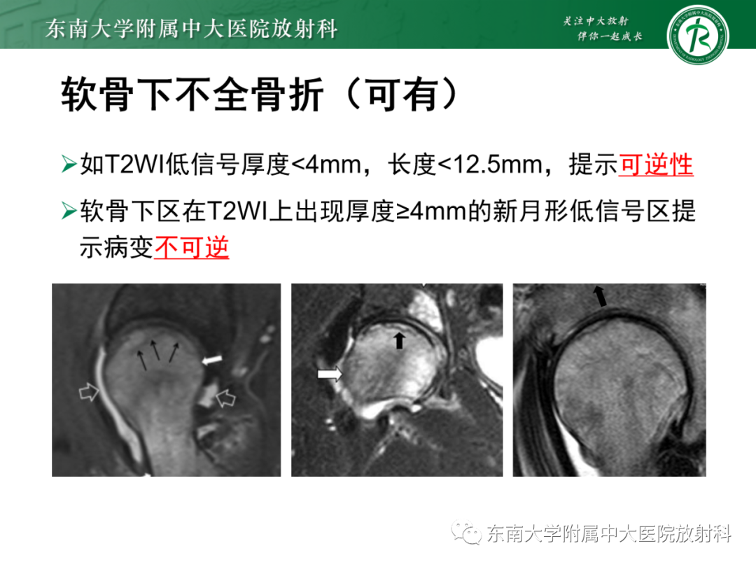 影像PPT - 【PPT】髋关节暂时性骨质疏松症TOH-16