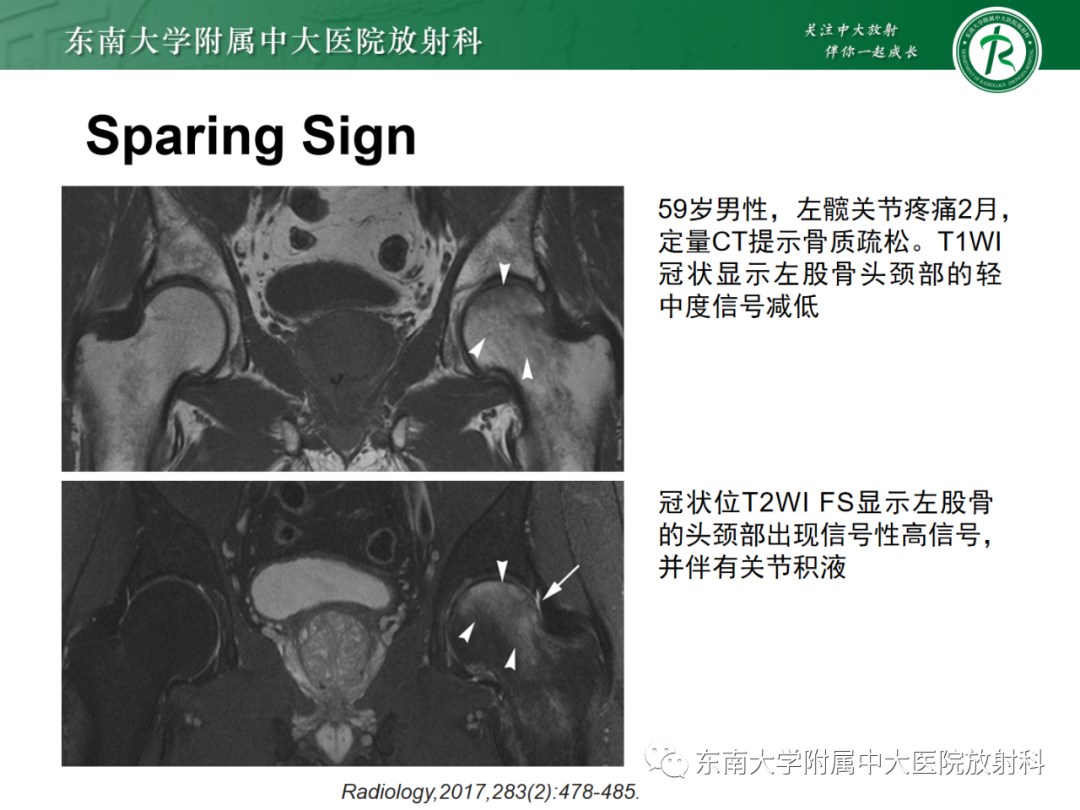 影像PPT - 【PPT】髋关节暂时性骨质疏松症TOH-15