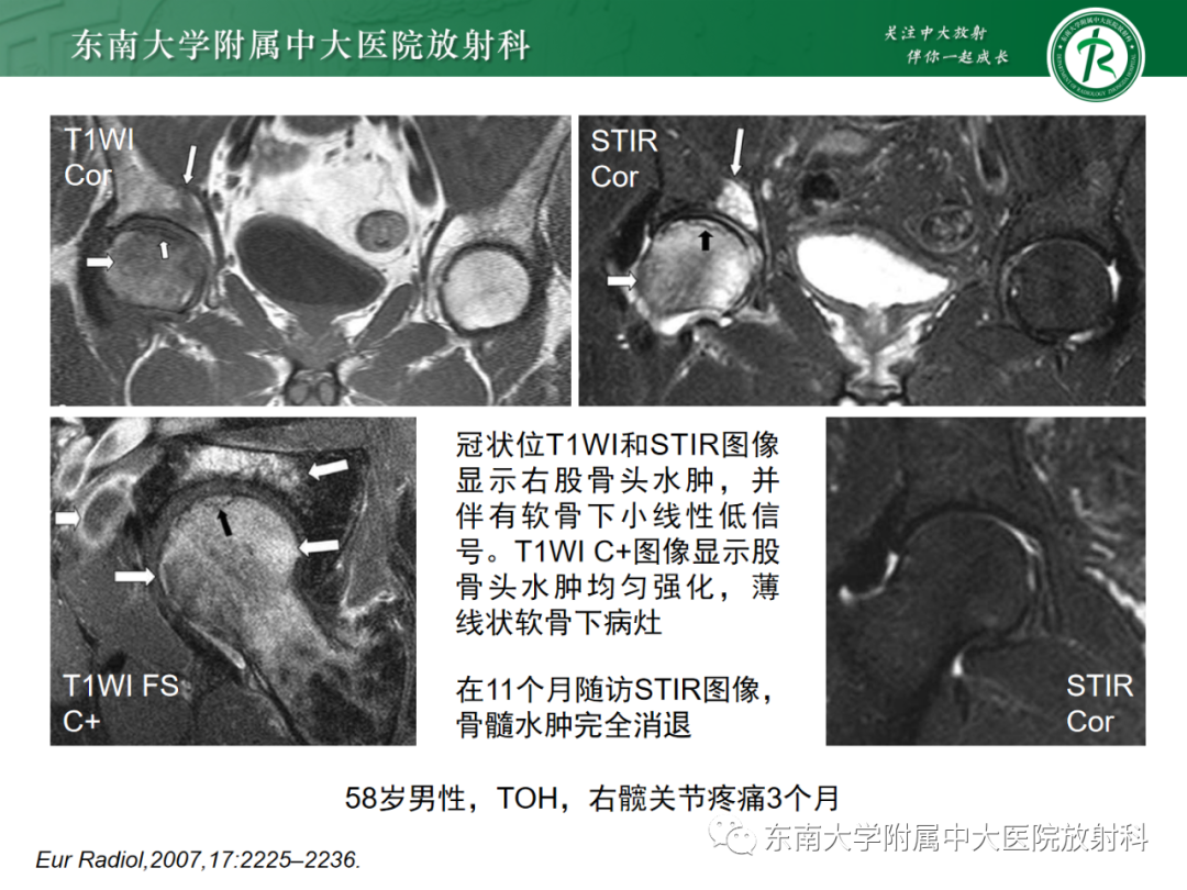 影像PPT - 【PPT】髋关节暂时性骨质疏松症TOH-17