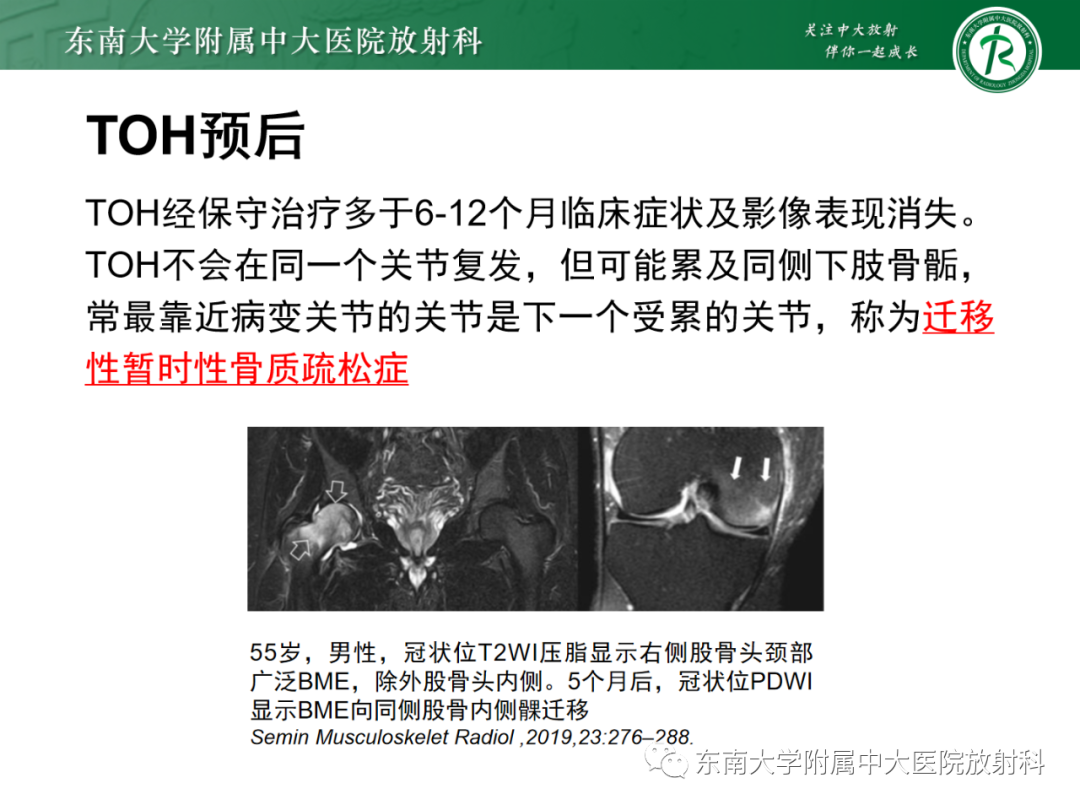 影像PPT - 【PPT】髋关节暂时性骨质疏松症TOH-18