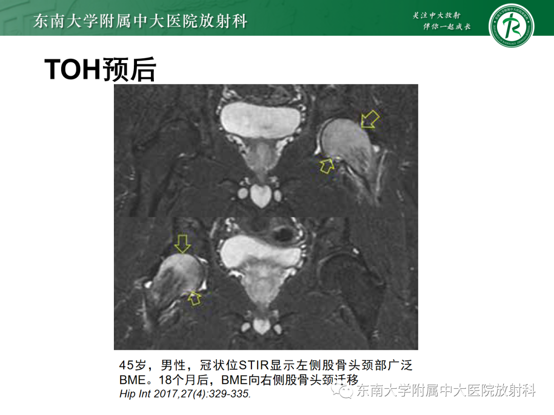 影像PPT - 【PPT】髋关节暂时性骨质疏松症TOH-19