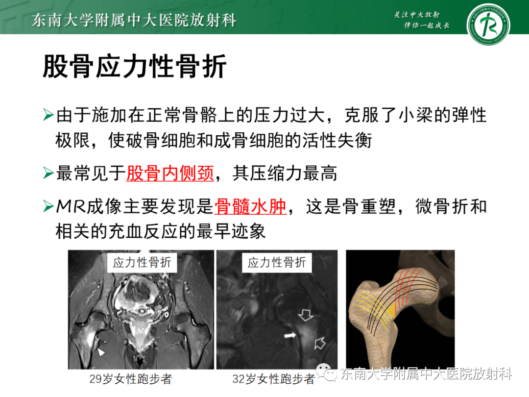 影像PPT - 【PPT】髋关节暂时性骨质疏松症TOH-23