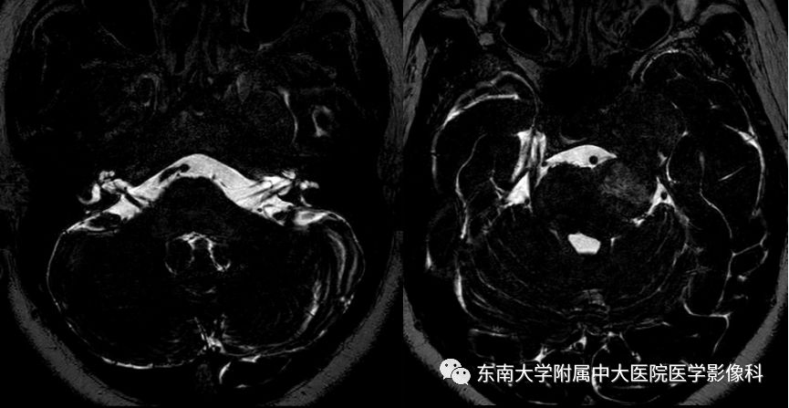 影像PPT - 【PPT】海绵窦区常见肿瘤性病变的影像-4