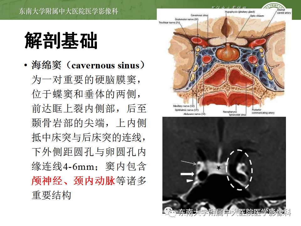 影像PPT - 【PPT】海绵窦区常见肿瘤性病变的影像-10