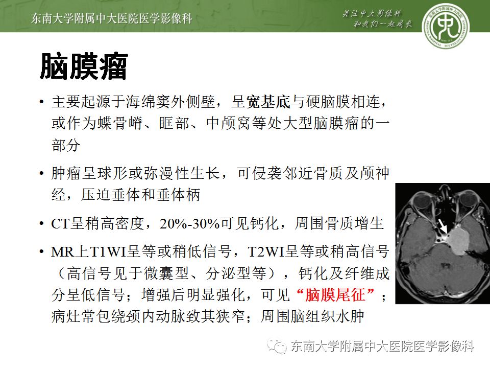 影像PPT - 【PPT】海绵窦区常见肿瘤性病变的影像-15