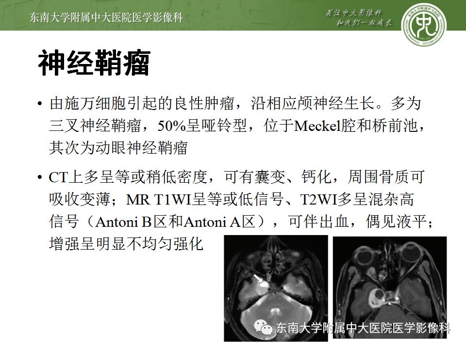 影像PPT - 【PPT】海绵窦区常见肿瘤性病变的影像-17