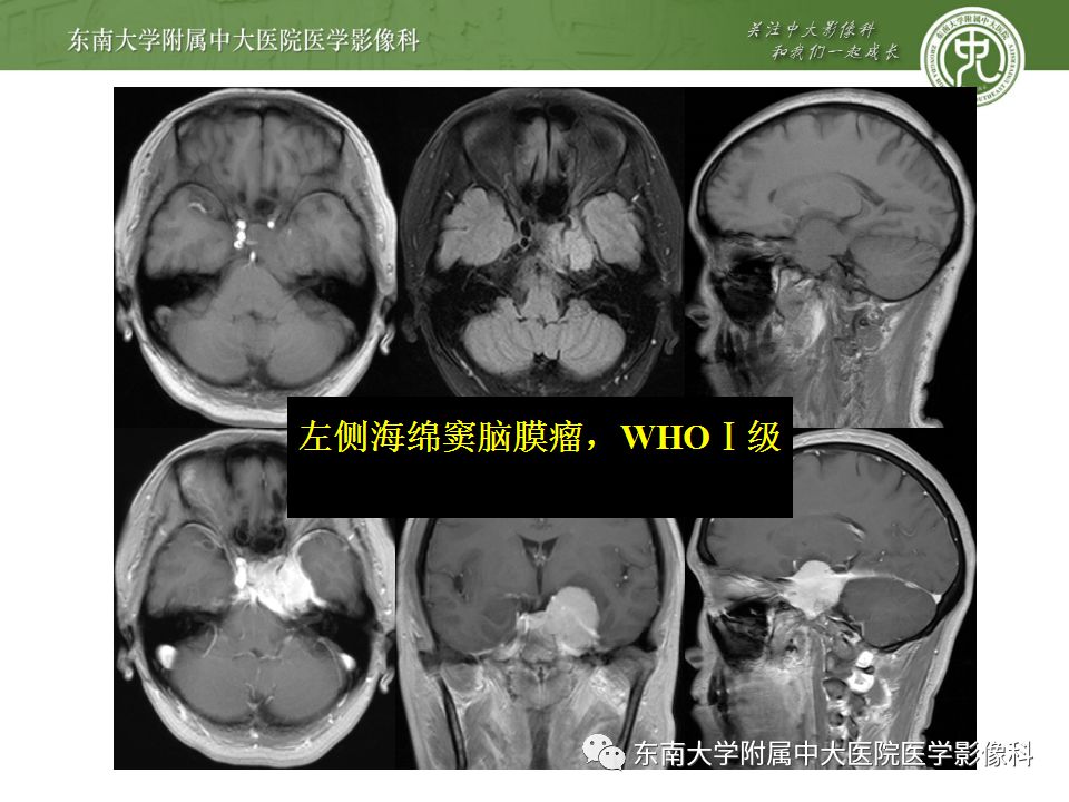 影像PPT - 【PPT】海绵窦区常见肿瘤性病变的影像-16