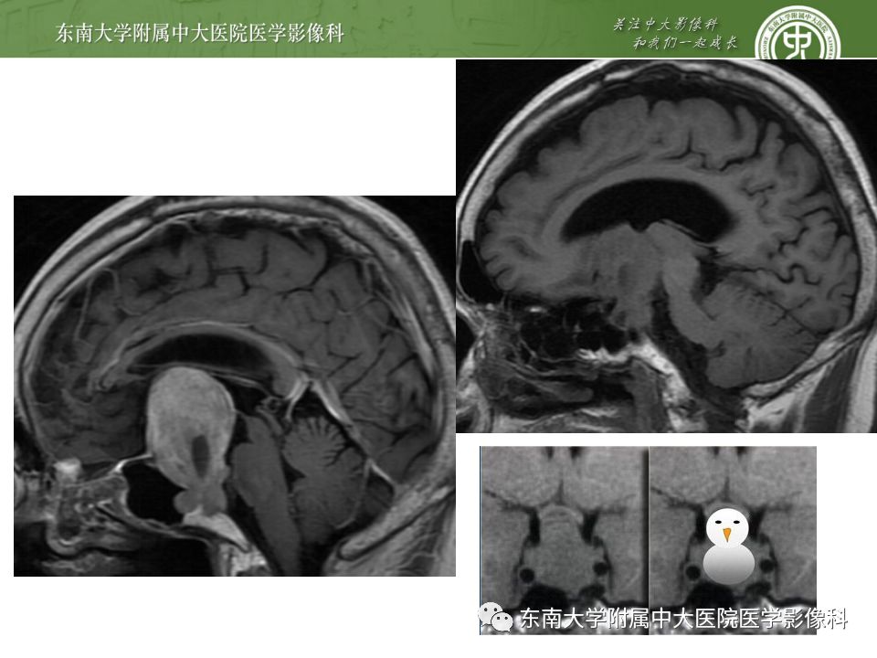 影像PPT - 【PPT】海绵窦区常见肿瘤性病变的影像-20
