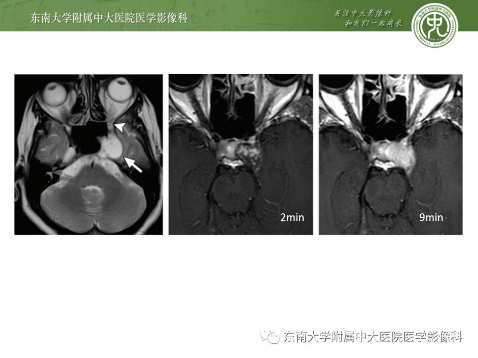 影像PPT - 【PPT】海绵窦区常见肿瘤性病变的影像-22