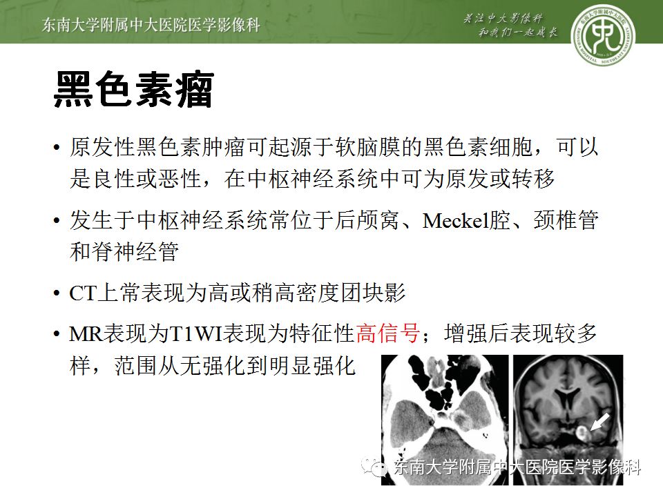 影像PPT - 【PPT】海绵窦区常见肿瘤性病变的影像-23