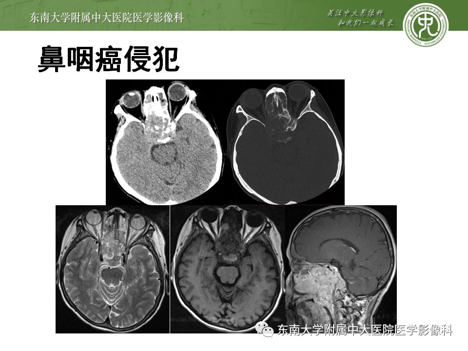 影像PPT - 【PPT】海绵窦区常见肿瘤性病变的影像-25