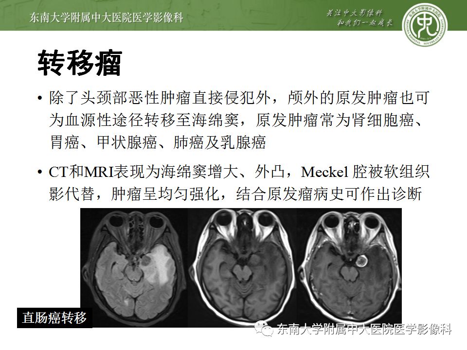 影像PPT - 【PPT】海绵窦区常见肿瘤性病变的影像-26