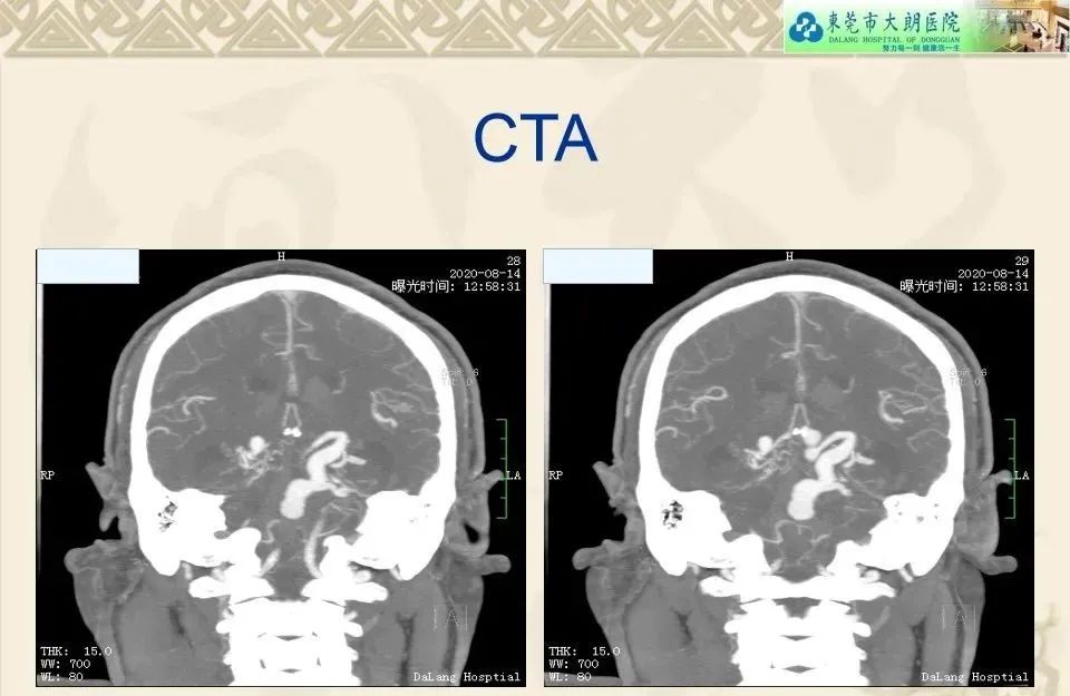 影像PPT - 【病例】硬脑膜动静脉瘘1例CT及DSA影像学表现-5
