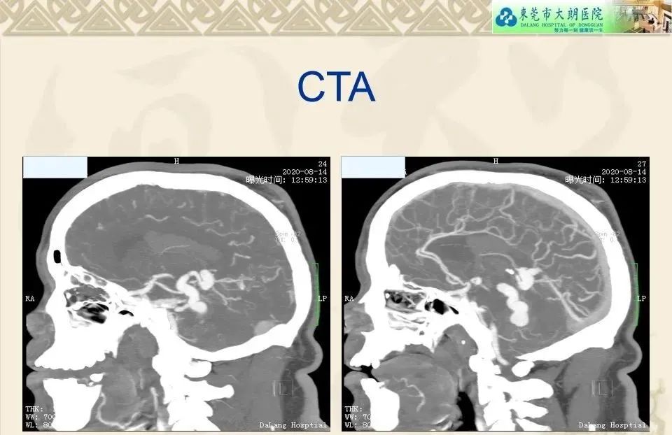 影像PPT - 【病例】硬脑膜动静脉瘘1例CT及DSA影像学表现-6