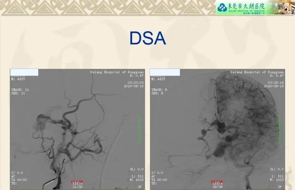 影像PPT - 【病例】硬脑膜动静脉瘘1例CT及DSA影像学表现-8