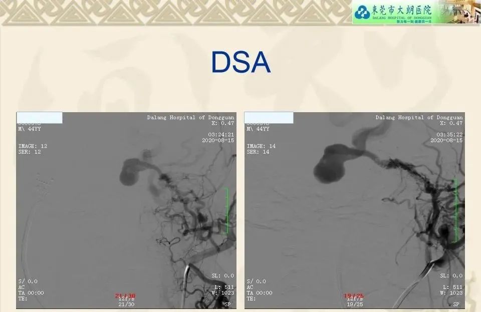 影像PPT - 【病例】硬脑膜动静脉瘘1例CT及DSA影像学表现-9