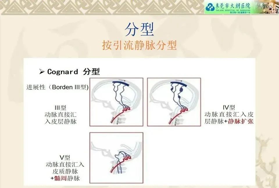 影像PPT - 【病例】硬脑膜动静脉瘘1例CT及DSA影像学表现-22