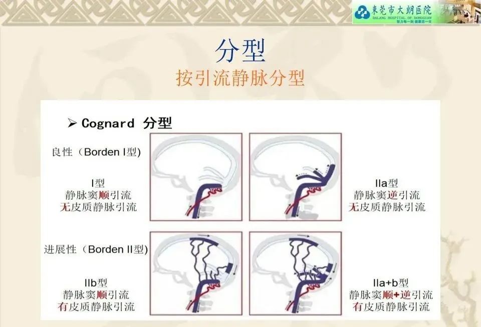 影像PPT - 【病例】硬脑膜动静脉瘘1例CT及DSA影像学表现-21