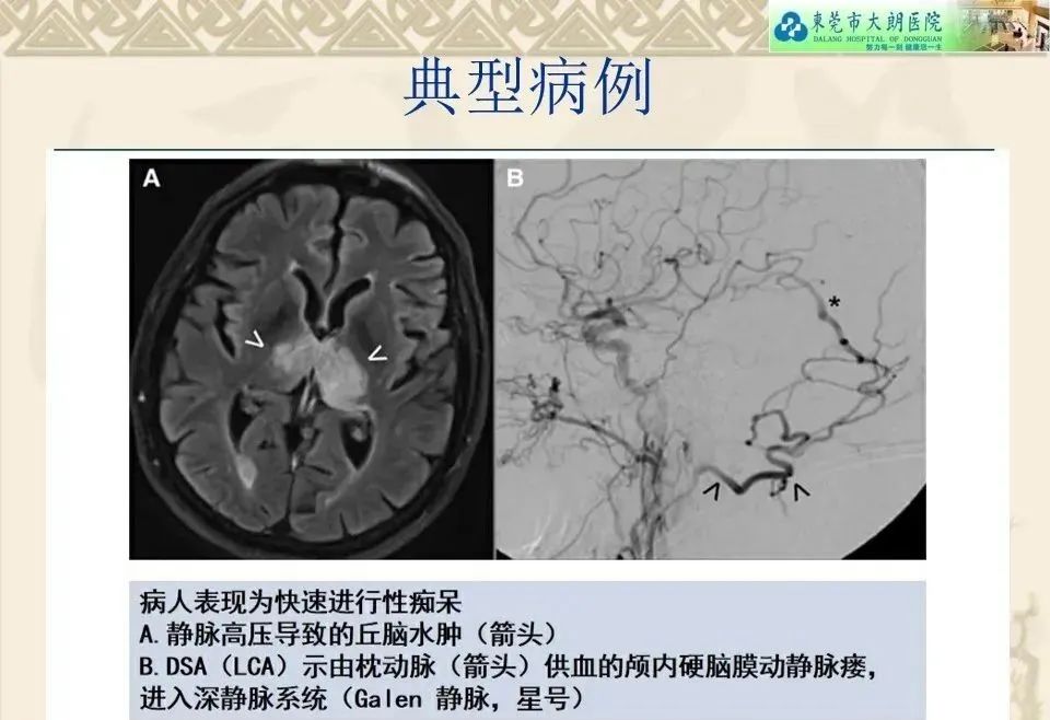 影像PPT - 【病例】硬脑膜动静脉瘘1例CT及DSA影像学表现-25