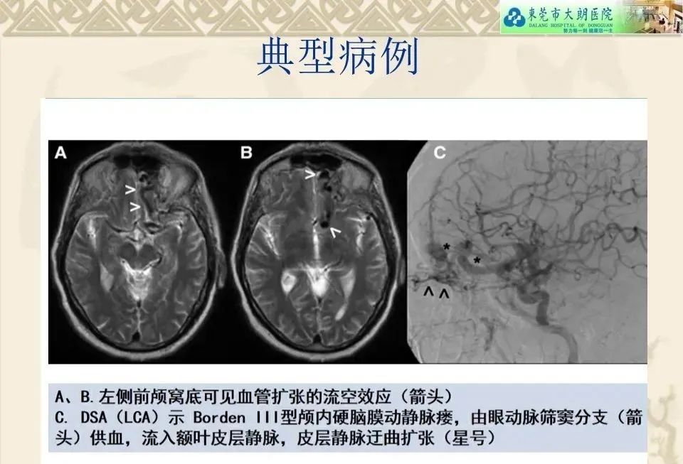影像PPT - 【病例】硬脑膜动静脉瘘1例CT及DSA影像学表现-26