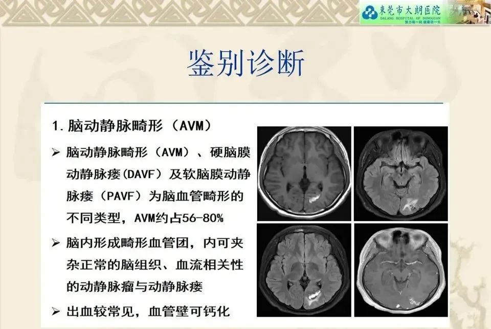影像PPT - 【病例】硬脑膜动静脉瘘1例CT及DSA影像学表现-28