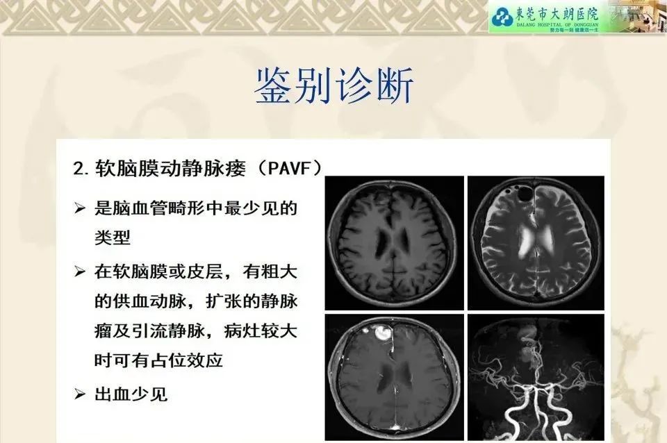 影像PPT - 【病例】硬脑膜动静脉瘘1例CT及DSA影像学表现-29