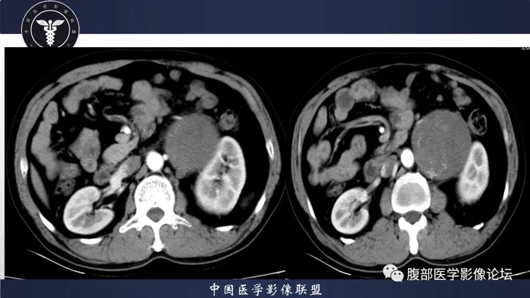 影像PPT - 【病例】腹膜后神经鞘瘤1例CT影像-5