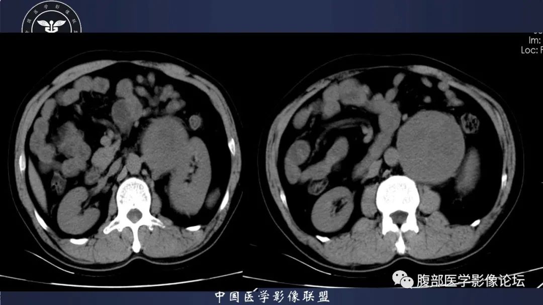 影像PPT - 【病例】腹膜后神经鞘瘤1例CT影像-3