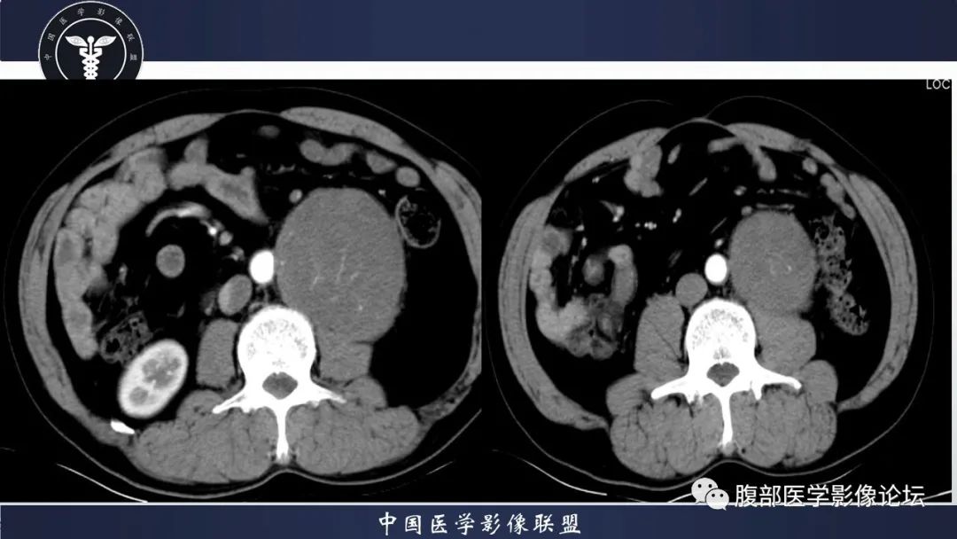 影像PPT - 【病例】腹膜后神经鞘瘤1例CT影像-6