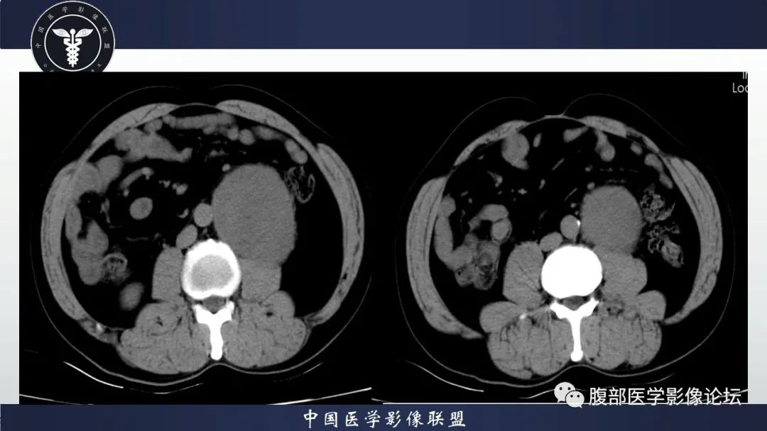 影像PPT - 【病例】腹膜后神经鞘瘤1例CT影像-4