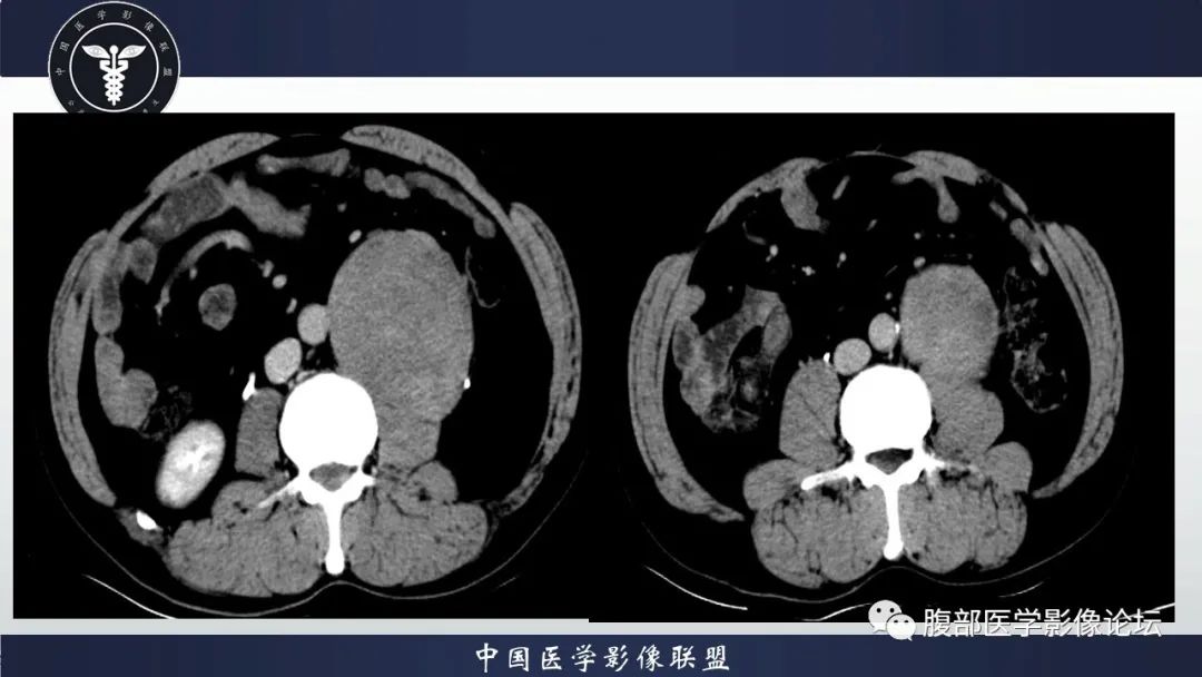 影像PPT - 【病例】腹膜后神经鞘瘤1例CT影像-8