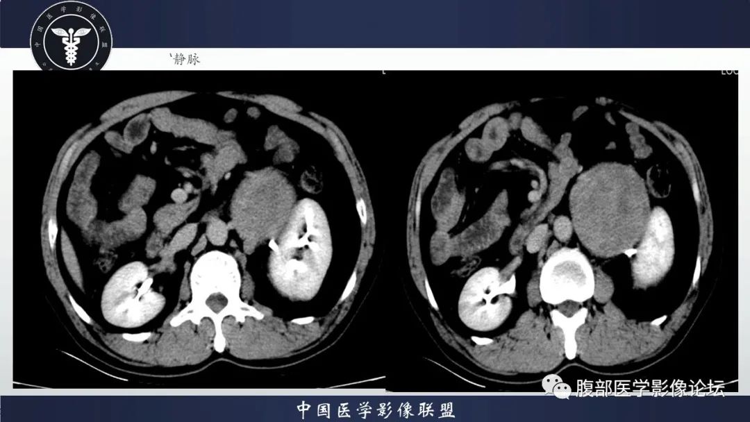 影像PPT - 【病例】腹膜后神经鞘瘤1例CT影像-7
