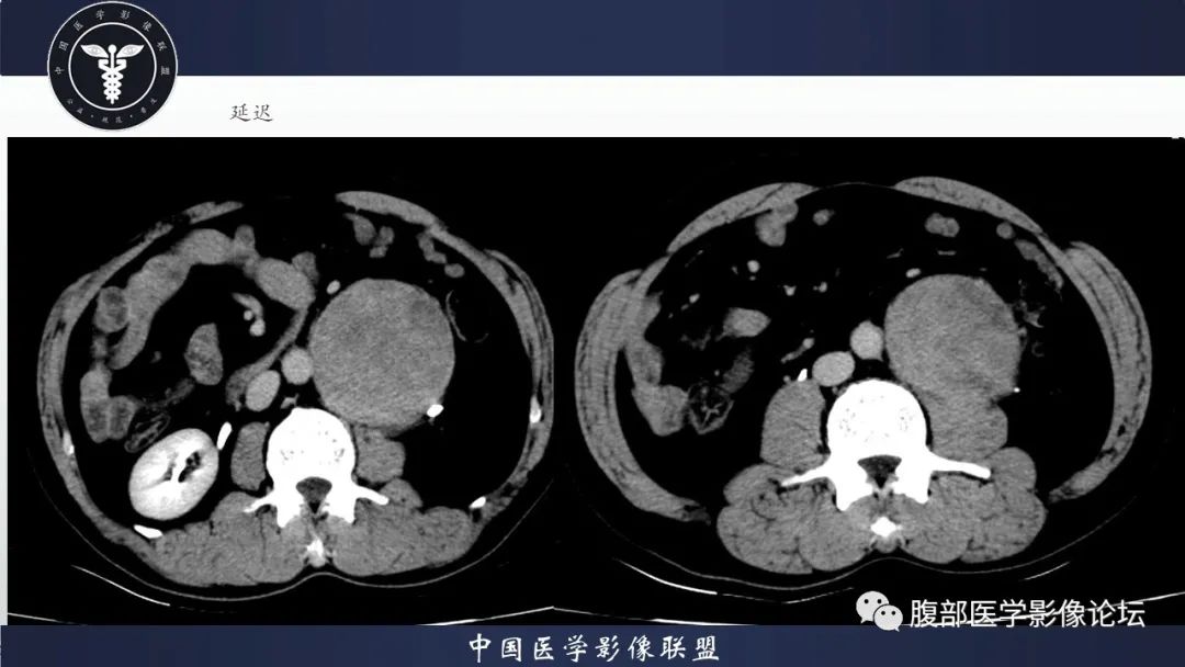 影像PPT - 【病例】腹膜后神经鞘瘤1例CT影像-9