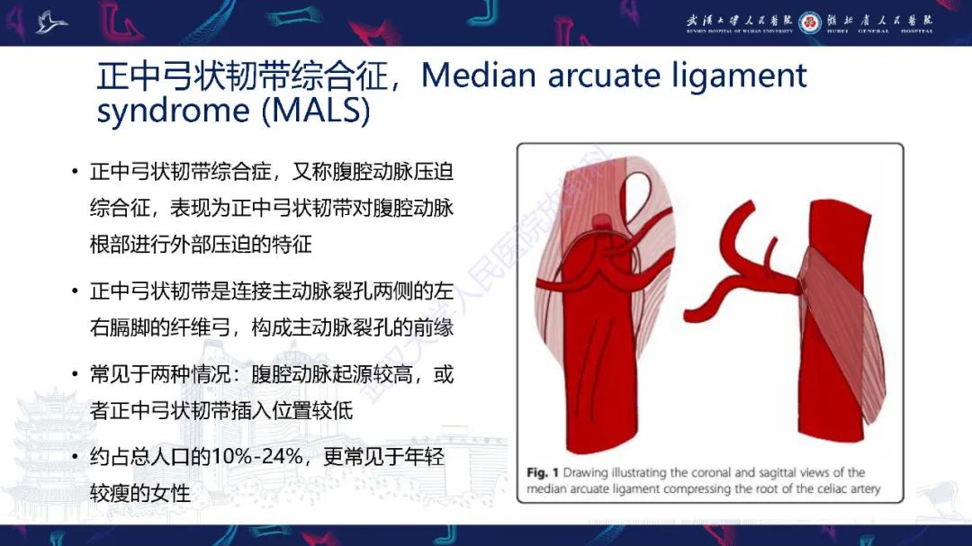 影像PPT - 【PPT】腹盆腔血管压迫综合征CT诊断-4