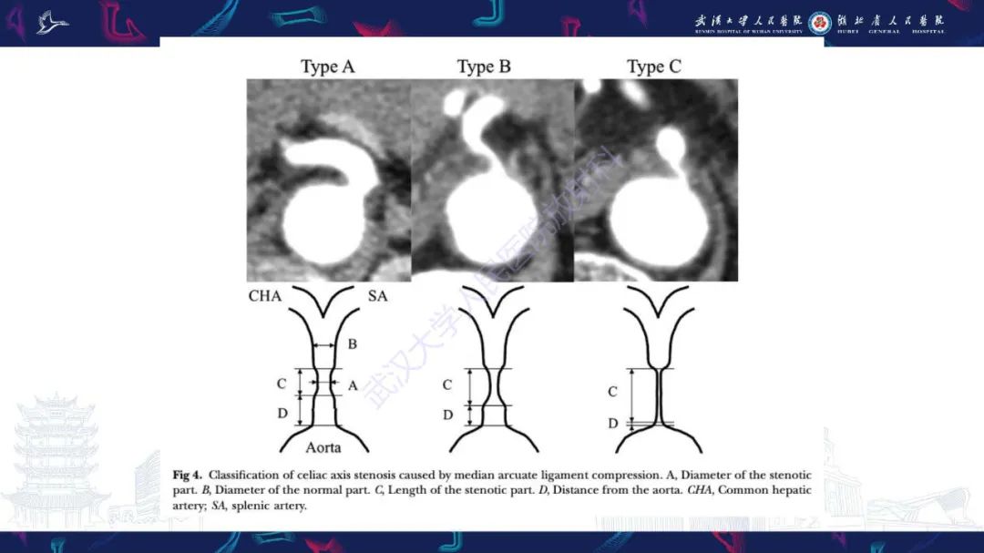 影像PPT - 【PPT】腹盆腔血管压迫综合征CT诊断-7